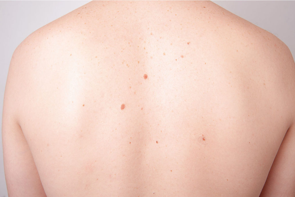 Full Body Imaging/ Mole Mapping/ Total body Photography Main Street